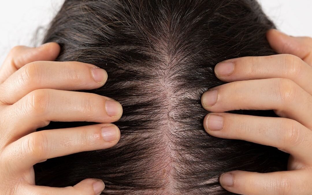 Polycystic Ovarian Syndrome & Hair Loss